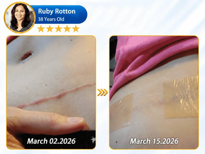 🦄⚕️𝐎𝐟𝐟𝐢𝐜𝐢𝐚𝐥 𝐒𝐭𝐨𝐫𝐞丨Dr.Fachmer® 🩹 Bio-Regenerative Microneedle Scar Tape——Remove all kinds of skin scars
